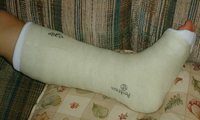 Julia's leg cast