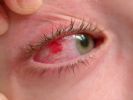 Conjunctivitis, Right Eye - click for larger picture